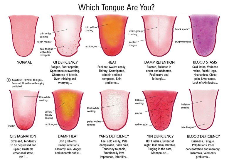 Swollen White Tongue Coating