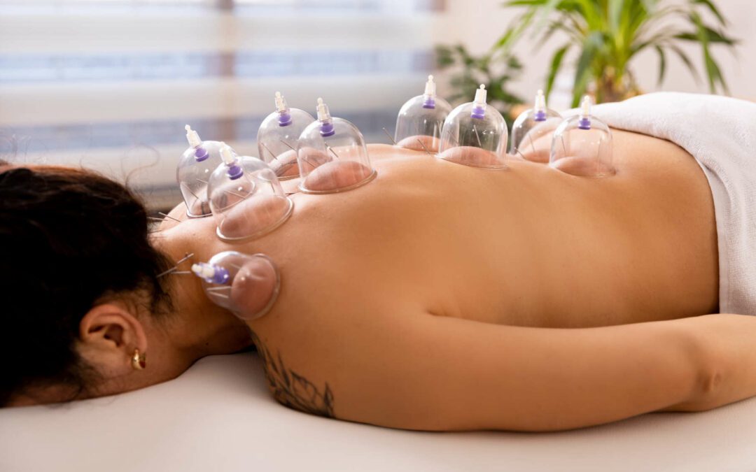 Cupping Aftercare