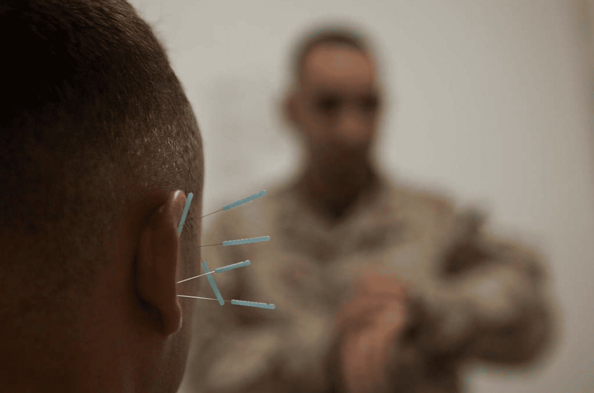 What to Know About Battlefield Acupuncture